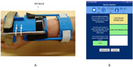 Figure 1: A) Image shows the Microsoft Band in a 3D printed wrist orthotic with straps B) Shows the user interface of the Android based application. The top panel shows the values for the different physiological parameters (Heart rate, Galvanic skin resistance and skin temperature). There ae different buttons which allow users to report Autonomic Dysreflexia (on top) below which is a button to allow users to start and stop recording data and a text box which allows them to inform the researchers of their opinions or any notes.  