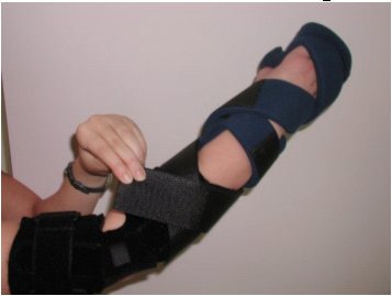 Figure 2 shows the elbow wrap and the hand splint modeled on a potential patient.  The hand splint, manufactured by Sammons-Preston, is made of a malleable aluminum frame that is covered with a removable soft blue lining.  The straps and removable finger separators are also made of this blue lining.  The splint holds the hand in a neutral arced position with a thumb strap and two straps that cover the fingers and the knuckles of the hand.  Two additional straps wrap around the forearm and the base of the hand splint.  These straps have been extended with 14 Velcro straps partially lined with 4 ¾  X 2  and 2 7/8  X 1 5/8  neoprene rectangles to serve as supination/pronation restraint straps.  These straps wrap around the arm in opposing directions. 