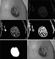 Figure shows a sequence of 6 images which demonstrate wound border detection. The first image shows the wound image. Images 2-4 show the edges found in the wound as they are dilated and filled. Image 6 shows the edge image when all edges in the wound have been connected and filled, the result is an image that is segmented so that all pixels within the wound bed are white and all pixels out of the wound bed are black. The edge of the white blob of pixels is taken as the wound border. Image 6 shows the wound border drawn on the original wound image. 