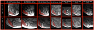 This figure displays a matrix of MRI scans, one column per subject. The top row shows the coronal plane near the peak of the IT with the gluteus maximus highlighted in red and the bottom row shows the sagittal plane near the peak of the IT with the gluteus maximus highlighted in red. There is great variation in the quantity of fat and muscle presented, with the most atrophy seen on Subject G, a 56 year old male with a T12 SCI. The other two subjects with a SCI have similar muscle quantities to the female, able-bodied participants. Finally, the gluteus maximus is seen next to, rather than underneath, the IT for most subjects (except for Subject C). 