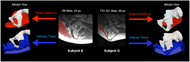 Sagittal MRI slices near the peak of the IT for Subjects B and G are presented at the center of this figure, with the gluteus maximus highlighted in red. From each scan are two arrows, pointing to 3D renderings of one side of the pelvis, along with renderings of the gluteus maximus (top) and subcutaneous adipose (bottom).  The gluteus maximus for Subject B is much bulkier and extends closer to the IT than Subject G, who has a very thin muscle far from the inferior aspect of the IT. The adipose tissue is presented as a hollow object cut open with the top layer representing the interface nearest the ischium. For Subject B, the adipose tissue is very flat and of equal thickness as you move anterior and posterior. Subject G shows a highly contoured surface that wraps closely around the ischium. 