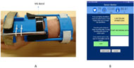 Figure 1: A) Image shows the Microsoft Band in a 3D printed wrist orthotic with straps B) Shows the user interface of the Android based application. The top panel shows the values for the different physiological parameters (Heart rate, Galvanic skin resistance and skin temperature). There ae different buttons which allow users to report Autonomic Dysreflexia (on top) below which is a button to allow users to start and stop recording data and a text box which allows them to inform the researchers of their opinions or any notes.
