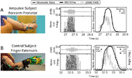 Figure 2. (A) The test results measured from the forearm pronator during intended forearm pronation/supination of a representative amputee, and  (B) the test results measured during finger flexion/extension from the finger extensor muscles of a representative control. MU Drive consistently provides smoother signals that better replicate intended limb movement than the RMS signals. 