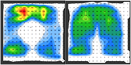 Seat with permanent opening pressure map (mmHg) (left), normal seat (right). The permanent opening seat provides no support to the pelvic floor, and focuses pressure at the buttocks and tailbone. The normal seat distributes pressure more evenly