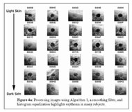 These 30 images that were processed using Algorithm 1, a smoothing filter, and histogram equalization, highlight erythema in many subjects.