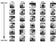 These 30 images that were processed using Algorithm 2, a smoothing filter, and histogram equalization, highlight erythema in some different subjects from Figure 4a.