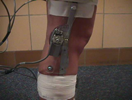This photo shows the knee goniometer mounted on the lateral side of the right knee while the subject is in the standing position with the knee fully extended.  The two arms of the parallelogram linkage opposite the potentiometer are aligned with the femur and tibia respectively and are fixed to the subject with tape.  In this position the parallelogram linkage of the goniometer is almost fully collapsed.