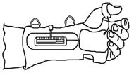 This figure shows a line drawing of the palmar view of the orthosis fitted to the hand of a tetraplegic.  The hand is slightly flexed so that the thumb grip is slightly opened.