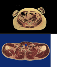 Cross-section of lumbar and shoulder, from the Visible Human Project.  These picture shows the cut model of human trunk.  One picture is cross section of lumbar.  It has large fat area under skin.  Another picture is cross section of upper shoulder.  Fat area is smaller than lumbar part.  Large bone of arm and various muscles of upper chest and arm are significant.