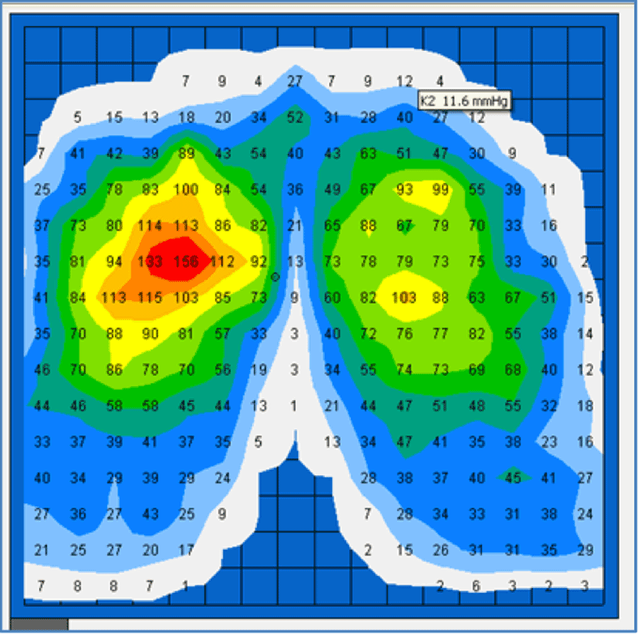 CORRELATING AIR CUSHION PRESSURE TO MAXIMUM INTERFACE PRESSURE ON THE  BUTTOCKS